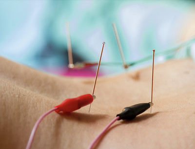 Link to: /pages/electro-acupuncture-or-tens